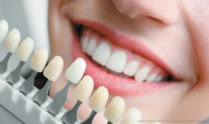 Benefits of opting for cosmetic dentistry