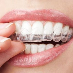 Invisible Aligners vs. Traditional Braces: Which Is Right For You?
